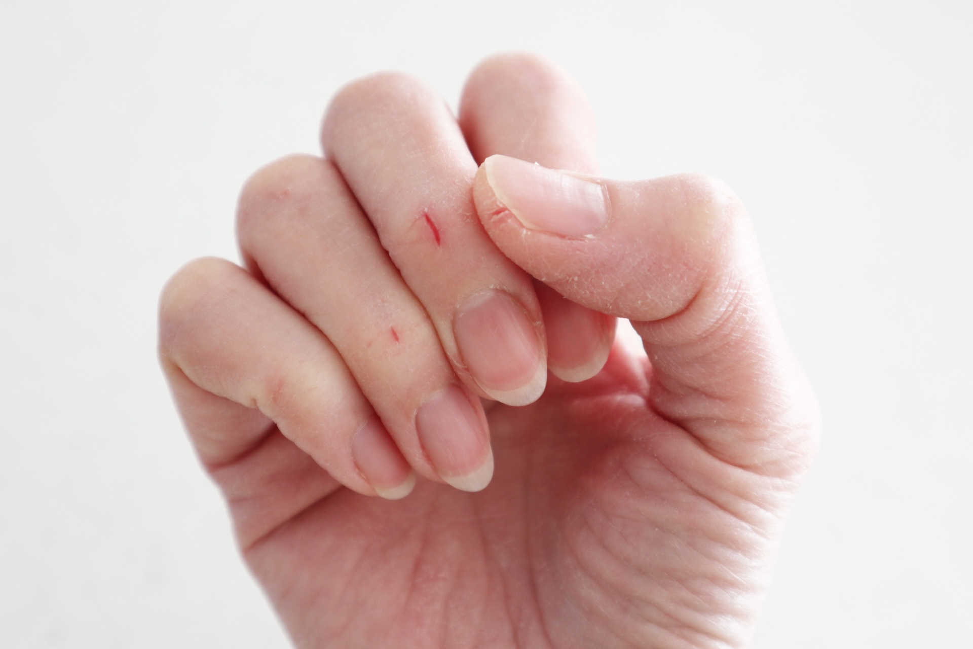 しもやけ・あかぎれ|手足の末梢冷え・かゆみ・ひび割れを鉄・ビタミンE・末梢循環から整える分子栄養学