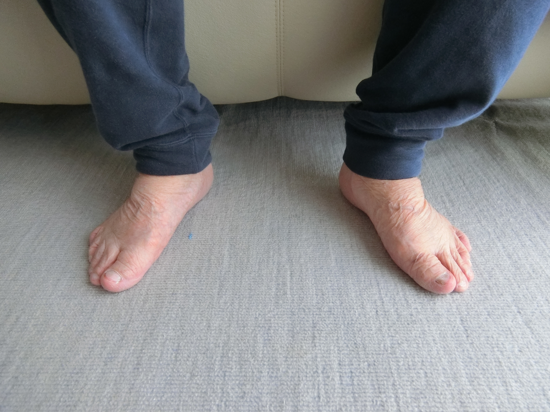 CKD・腎臓とむくみ:経皮マグネシウムの重要性