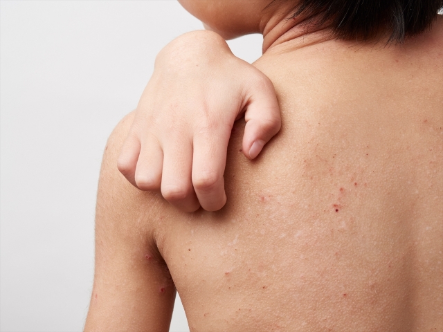 あせも・汗かぶれは「大人」にも起こる——汗腺の詰まりと皮膚バリアを亜鉛・ビタミンA・オメガ3で立て直す分子栄養学