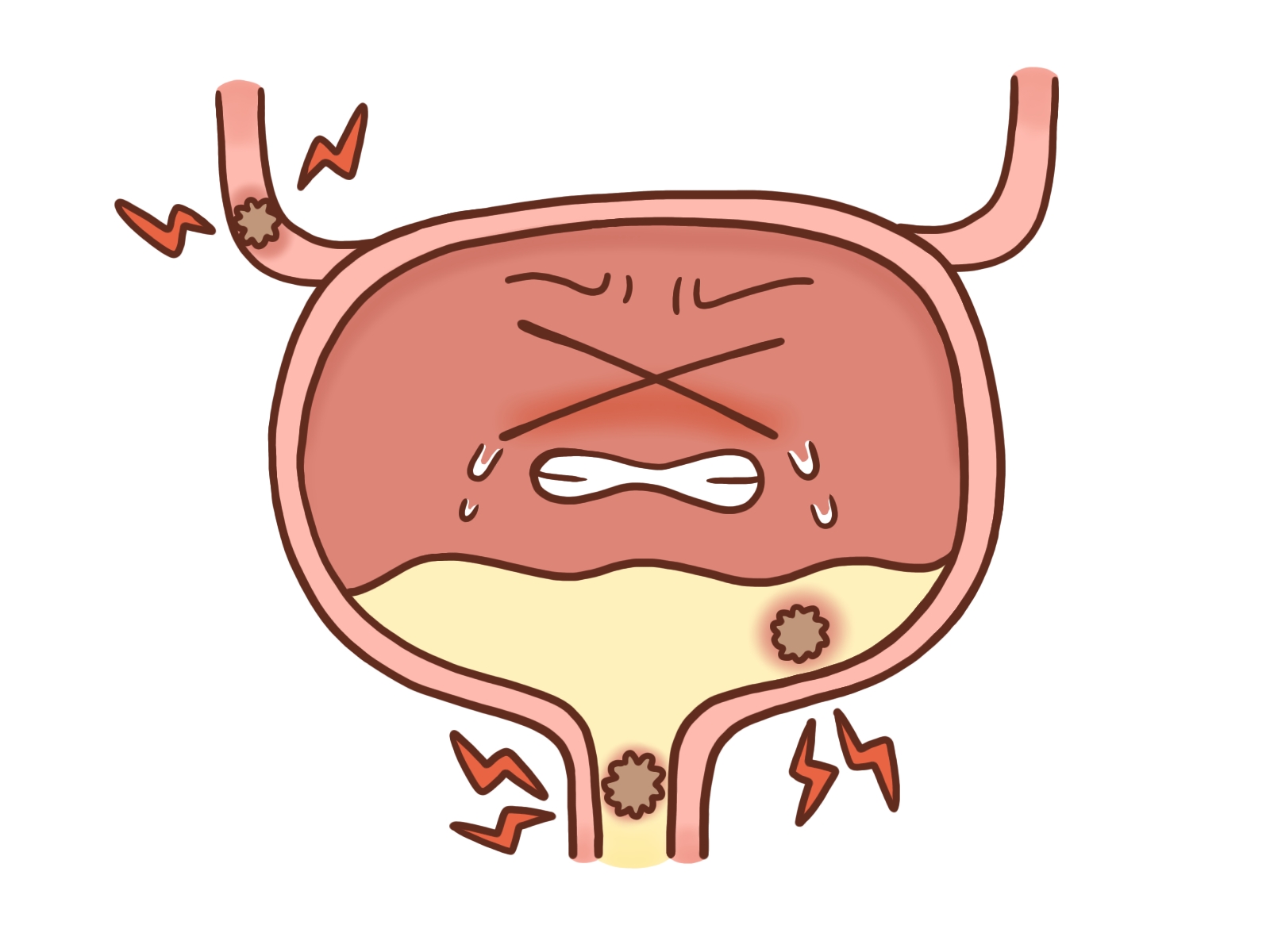 尿路結石はなぜ繰り返すのか——マグネシウム・クエン酸・ビタミンB6の結石抑制生化学