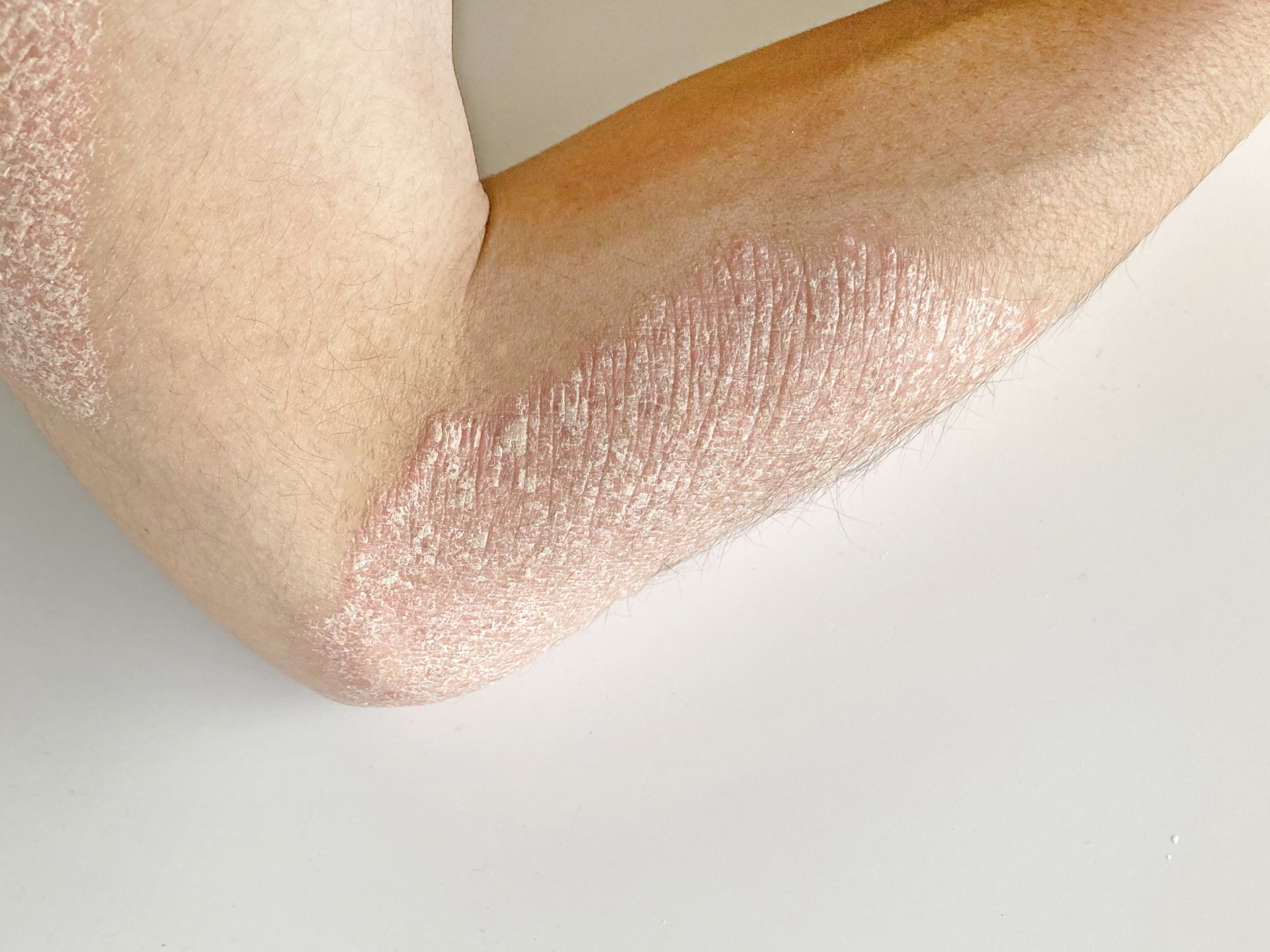 ステロイドを塗り続けるしかない?乾癬の炎症が止まらない本当の理由を分子栄養学で解説