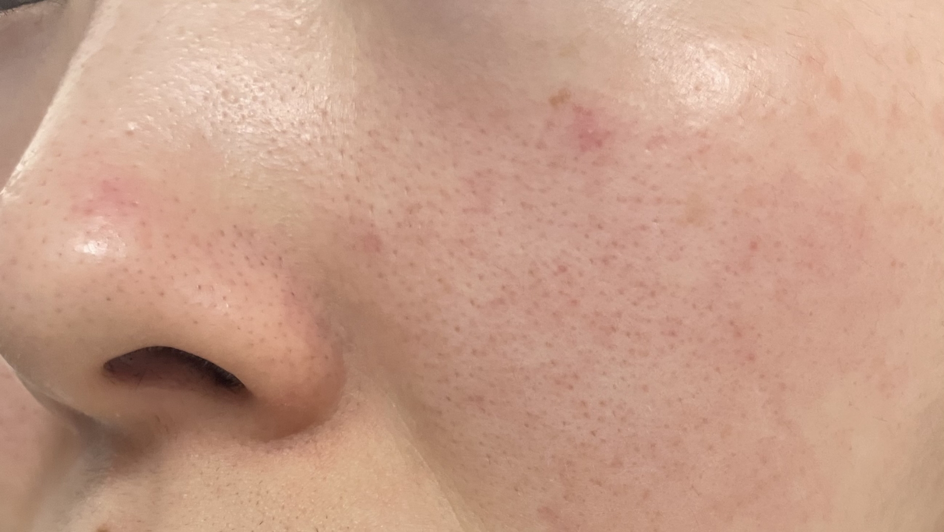 酒さ(しゅさ)・赤ら顔|頬の赤み・ほてり・ニキビ様発疹を腸・LPS・亜鉛・オメガ3から整える分子栄養学