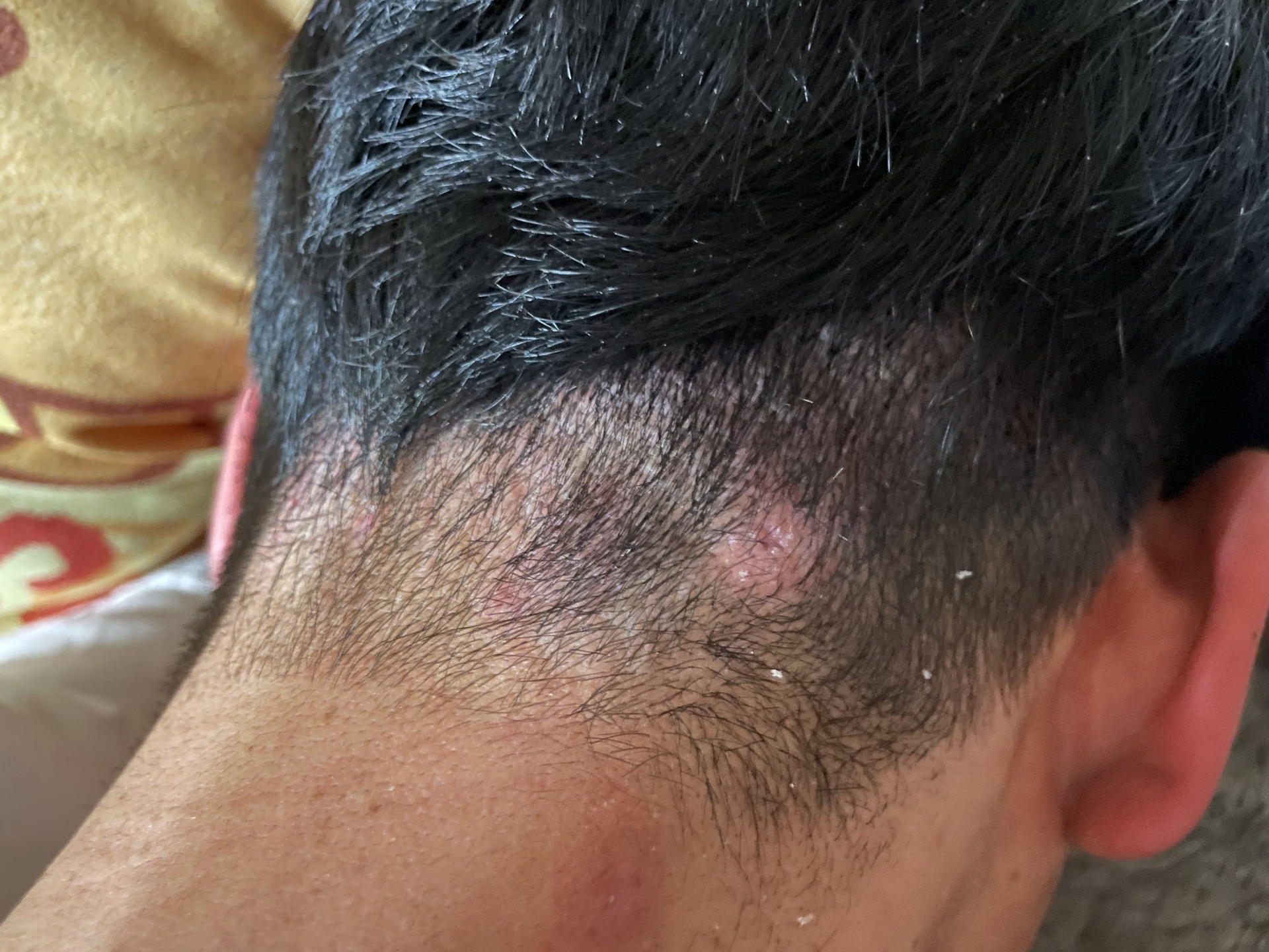 フケ・頭皮かゆみが消えない理由——脂漏性皮膚炎と亜鉛・ビオチン・ビタミンB群の皮膚生化学