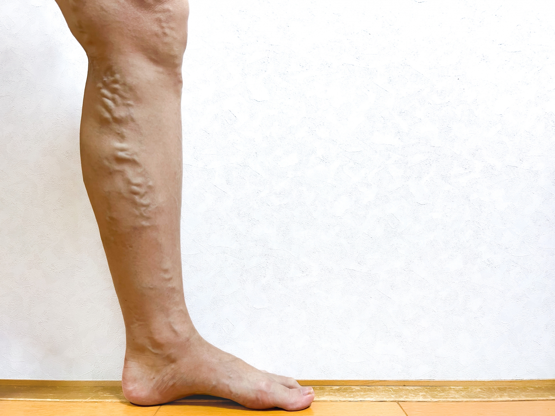 下肢静脈瘤は「年のせい」ではなかった。静脈弁を守るビタミンC・コラーゲン・オメガ3の生化学